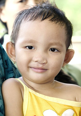 Nhi after cleft lip surgery