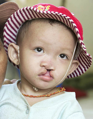 Nhi before cleft lip surgery